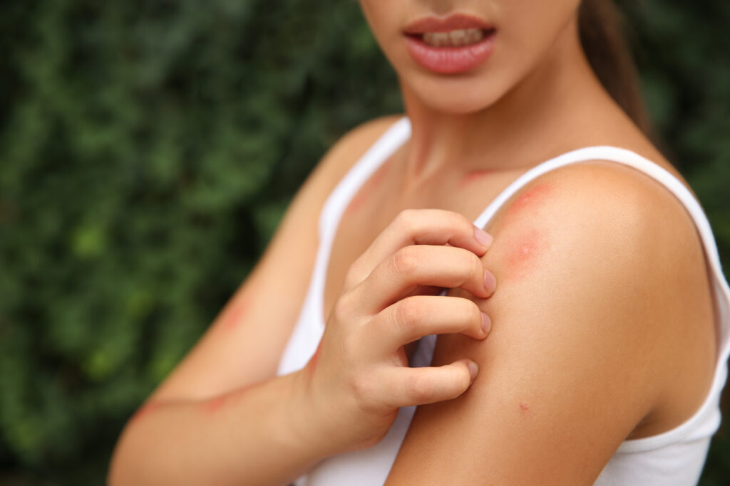 A person in a white tank top scratching red, irritated bumps on their upper arm, suggesting an itchy skin reaction, with a blurred green background.